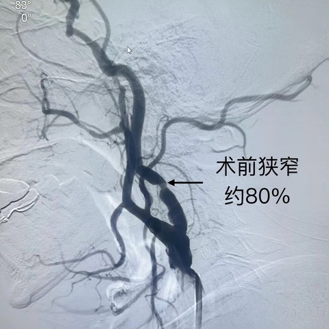 曲径通幽-颈动脉球囊扩张+支架成型术一例