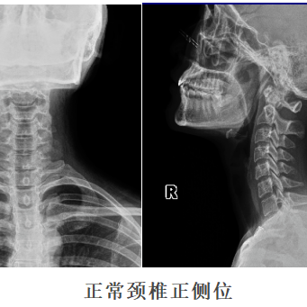 不可忽视的颈椎病