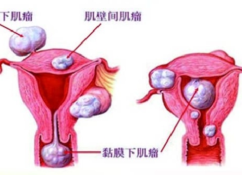 关爱女性患者，海扶刀技术健康知识讲座