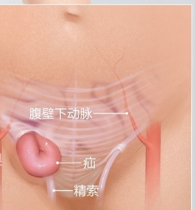 小儿疝气需早治，勿以“疝”小而不为