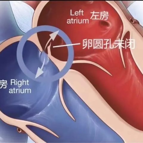 卵圆孔未闭——一种常被忽视的心脏病 南阳医专一附院东院区 神经内分泌科