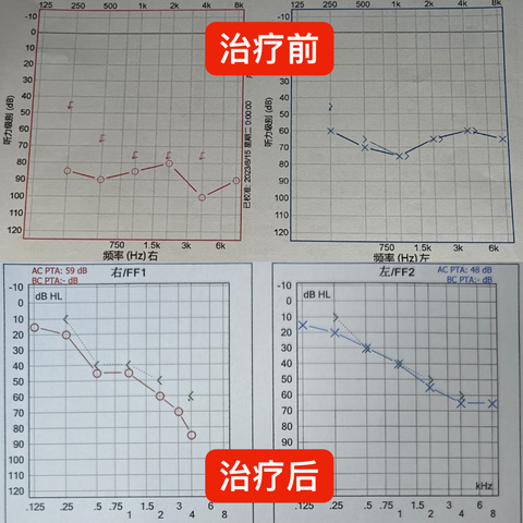 突发耳聋勿忽视，积极治疗可恢复！