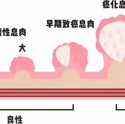 你真的了解你的肠道吗？今天让我们一起了解一个隐形的杀手——肠息肉。