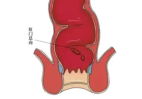 肠道长了息肉，身体会有什么样的提示？