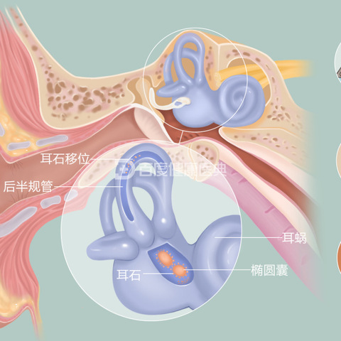 神经内科一病区——耳石症及手法复位