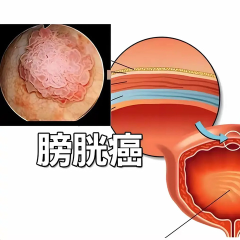 【科普】膀胱恶性肿瘤知多少，关注“膀胱癌”