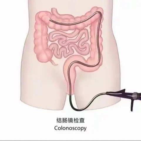 远离大肠癌，简单一招，如果患上真得太冤！