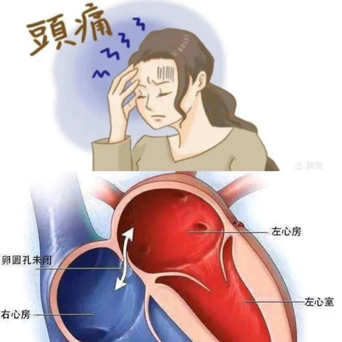 高陵区医院成功开展首例卵圆孔未闭封堵术