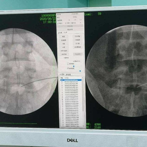 一例腰椎间盘突出射频消融微创手术病历分享