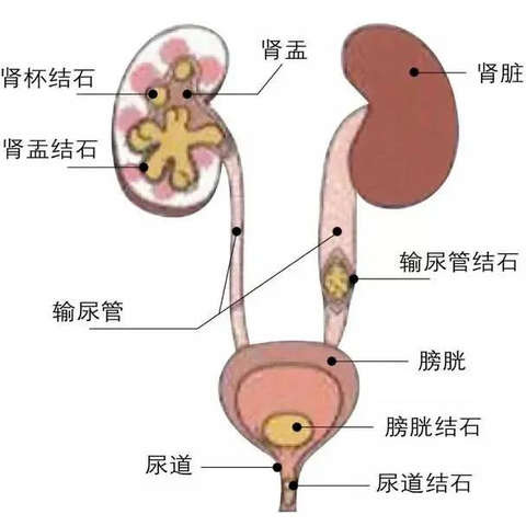 科普-关于泌尿系结石，那些你不知道的事