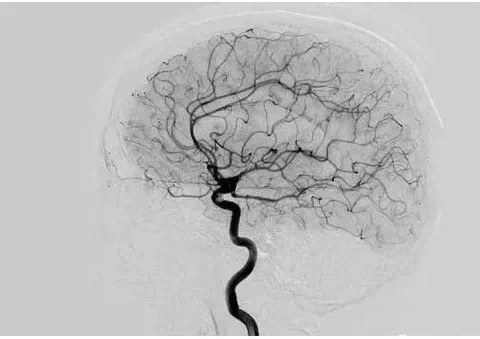 脑血管造影，你了解多少？