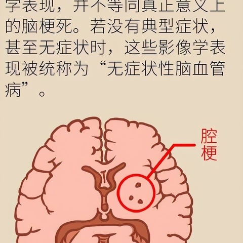 体检报告上的“腔隙性脑梗死”严重吗？