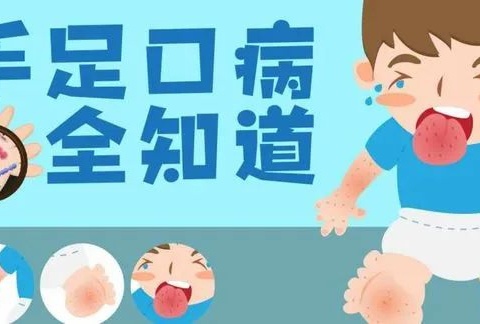 【卫生保健】“预防手足口、健康我先行”——手足口病预防知识