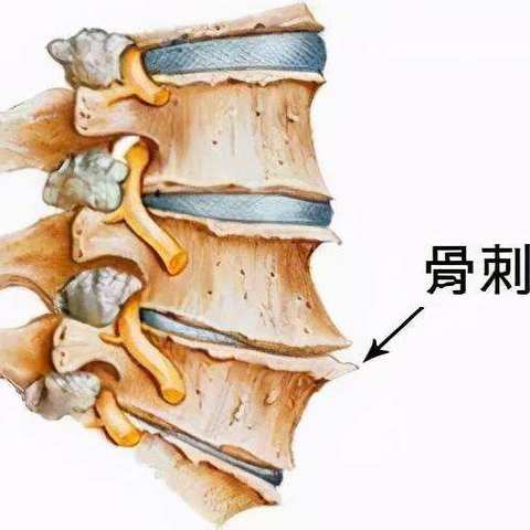 骨质增生是如何形成的？义和医院是如何治疗的?