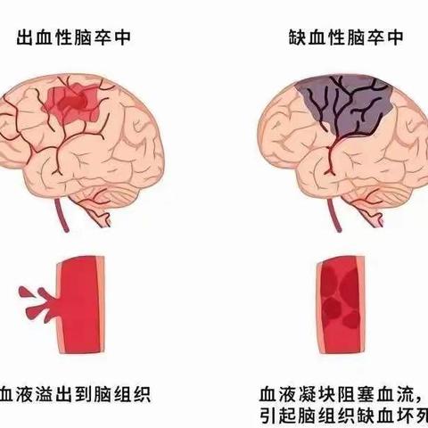 卒中防治，重在预防