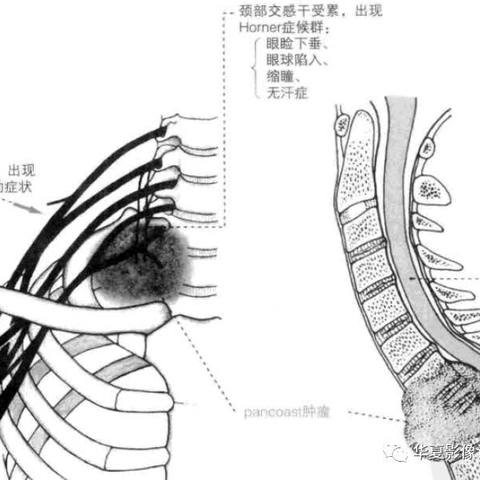 颈肩部“隐藏的杀手”—— 肺尖肿瘤综合征