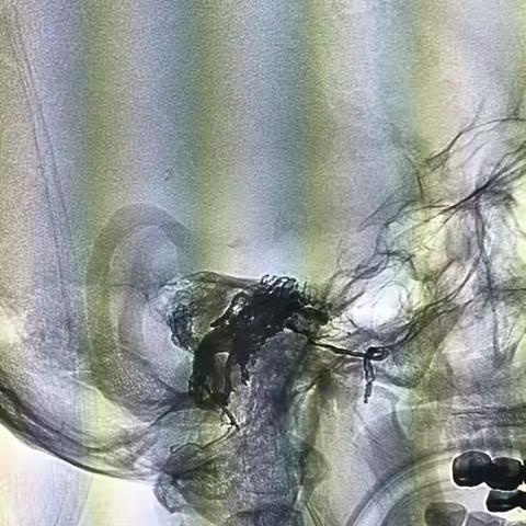 黄怡，DAVF，53岁。男性。