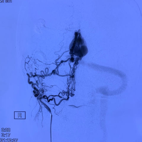 孙艳华，女，52岁，天幕DAVF。复查ct