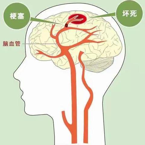 静脉溶栓--唯快不破！