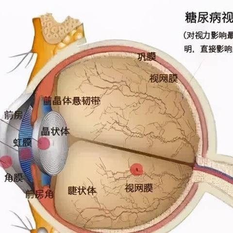糖尿病视网膜病变患者的护理