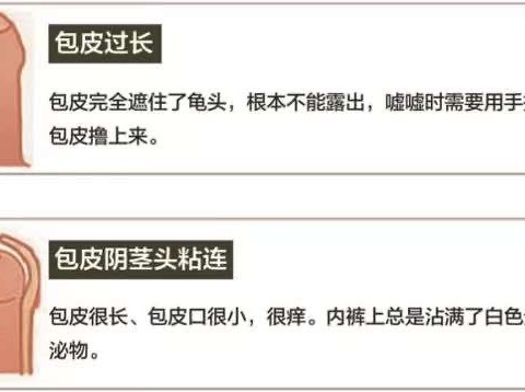 要不要割包皮？割完有什么注意事项？弄清楚这些很重要！