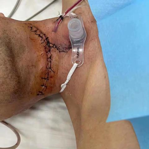 高陵区医院首例全喉切除、咽再造、颈部淋巴结清扫手术