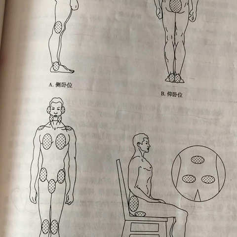 压疮的预防