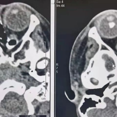 OAC治疗D期RB病例分享